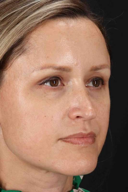 Rhinoplasty Before & After Patient #5870