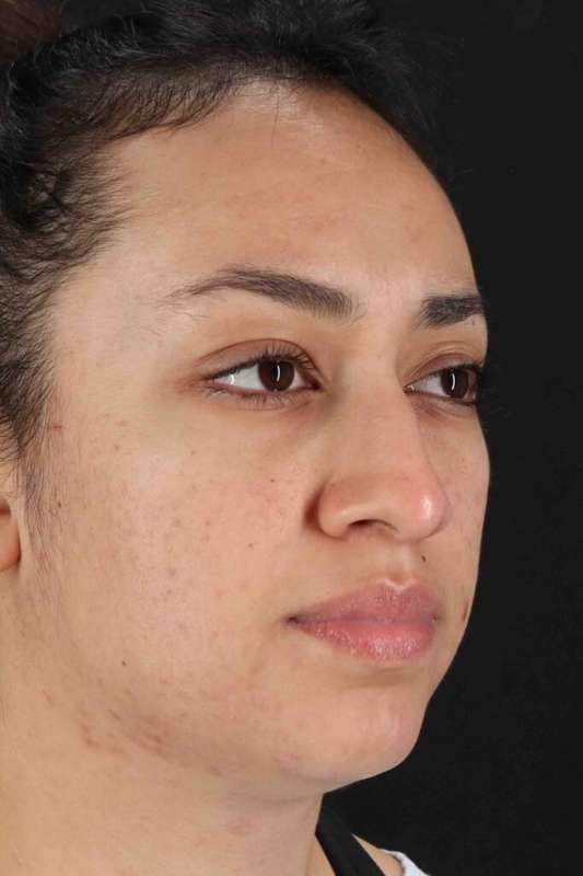 Rhinoplasty Before & After Patient #5881