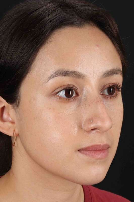 Rhinoplasty Before & After Patient #5892