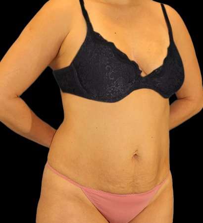 Abdominoplasty (Tummy Tuck) Before & After Patient #1083