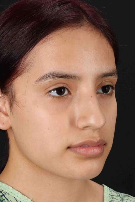 Rhinoplasty Before & After Patient #5903