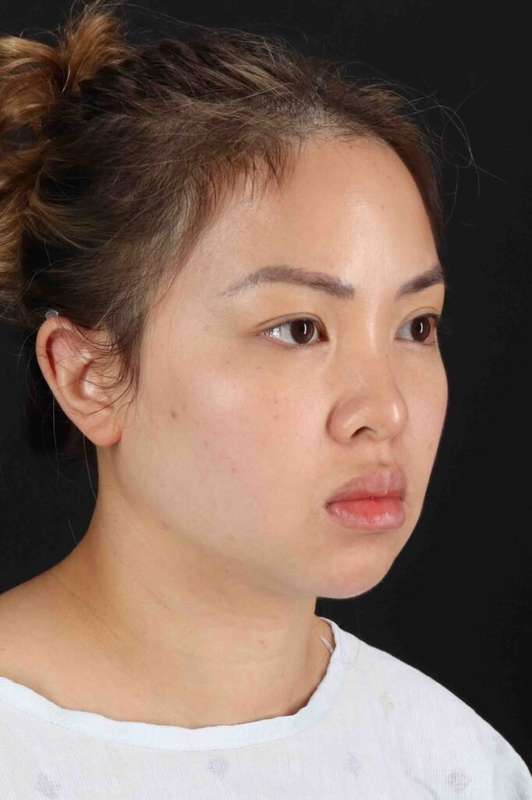Rhinoplasty Before & After Patient #5914