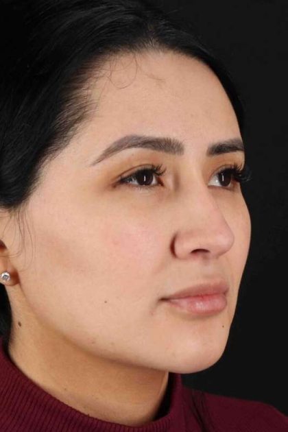 Rhinoplasty Before & After Patient #5925