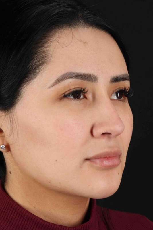 Rhinoplasty Before & After Patient #5925