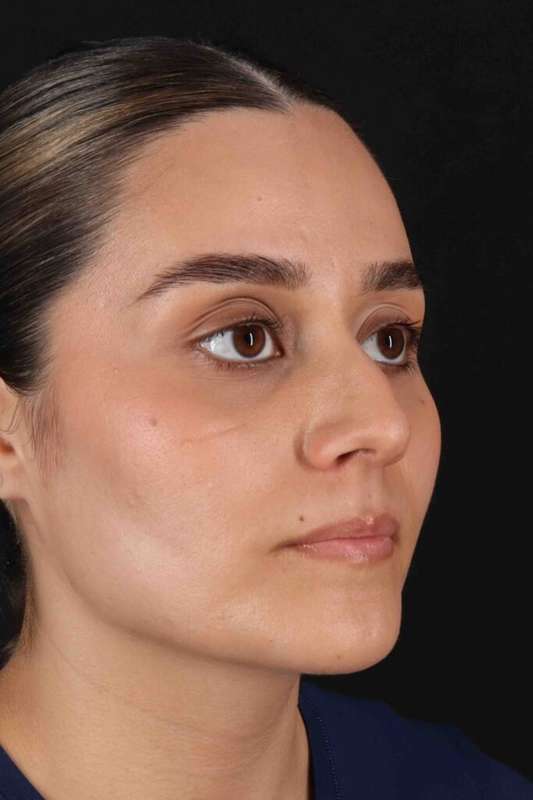 Rhinoplasty Before & After Patient #5947