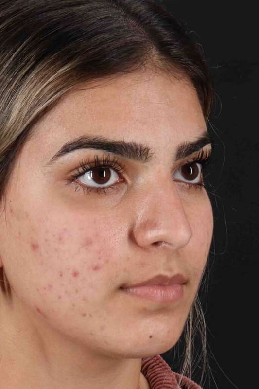 Rhinoplasty Before & After Patient #5958