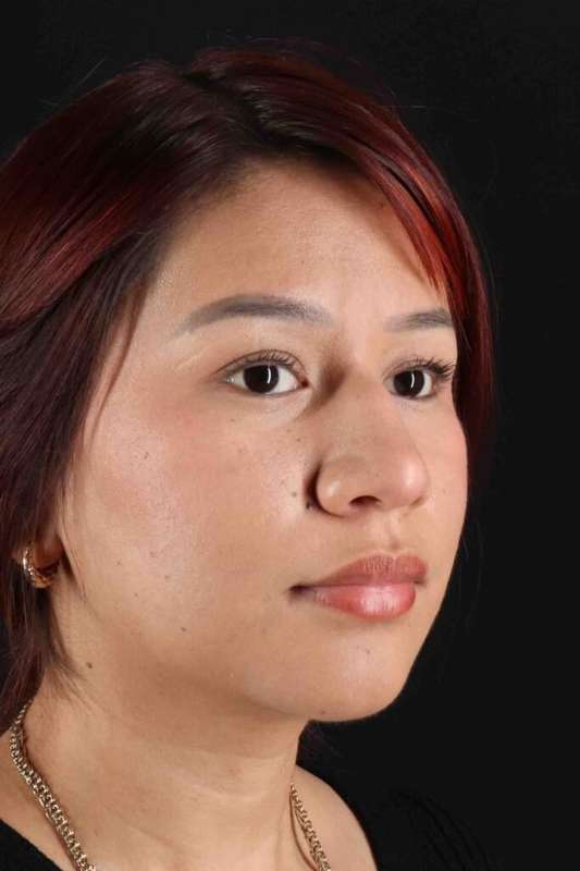 Rhinoplasty Before & After Patient #5983