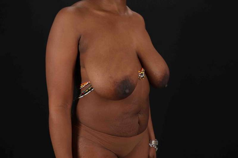 Abdominoplasty (Tummy Tuck) Before & After Patient #1099