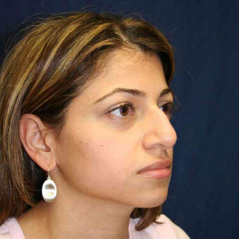 Rhinoplasty Before & After Patient #6021