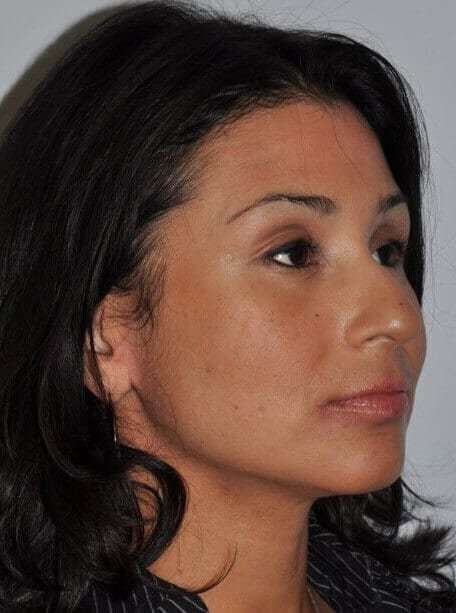 Rhinoplasty Before & After Patient #6035