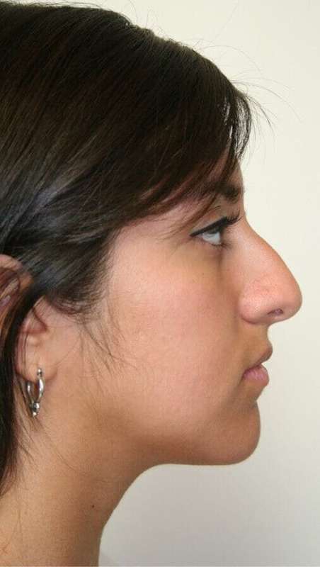 Rhinoplasty Before & After Patient #6040