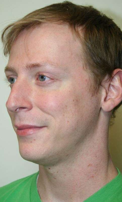 Rhinoplasty Before & After Patient #6047