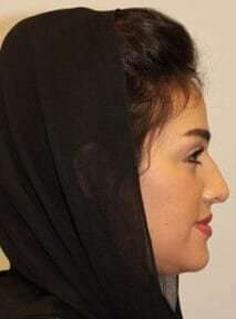 Rhinoplasty Before & After Patient #6054