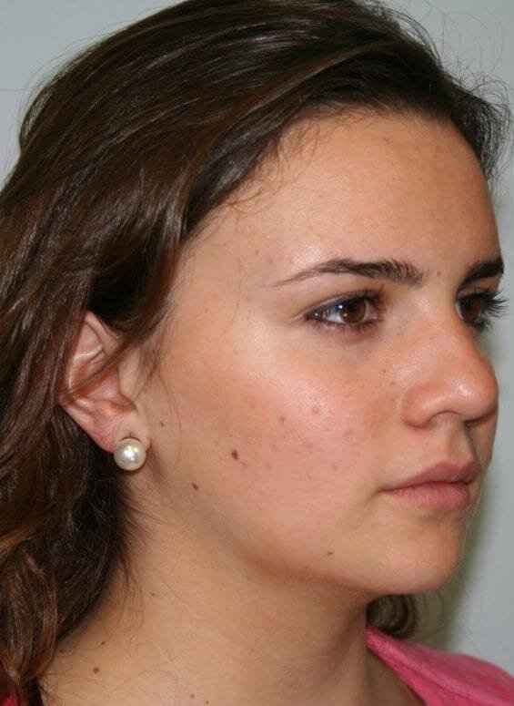 Rhinoplasty Before & After Patient #6075