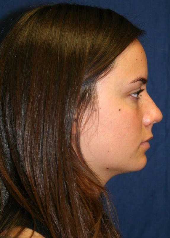 Rhinoplasty Before & After Patient #6080