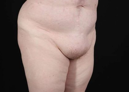 Monsplasty Before & After Patient #1117