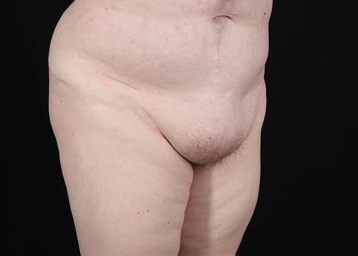 Monsplasty Before & After Patient #1117