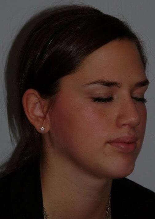 Rhinoplasty Before & After Patient #6092