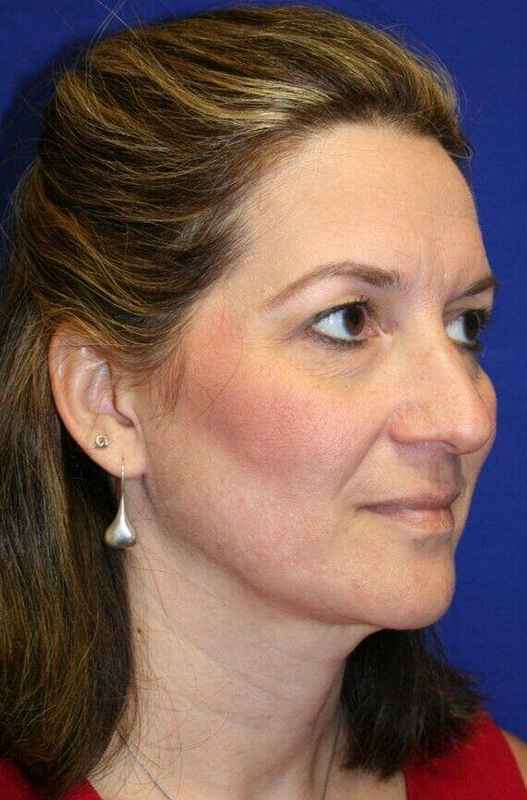 Rhinoplasty Before & After Patient #6099