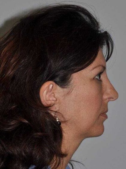 Rhinoplasty Before & After Patient #6125