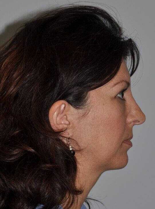 Rhinoplasty Before & After Patient #6125