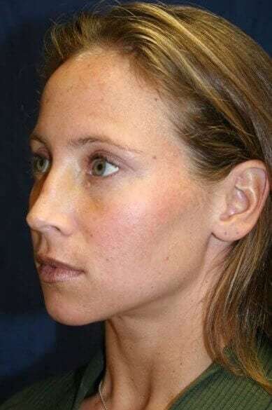 Rhinoplasty Before & After Patient #6132