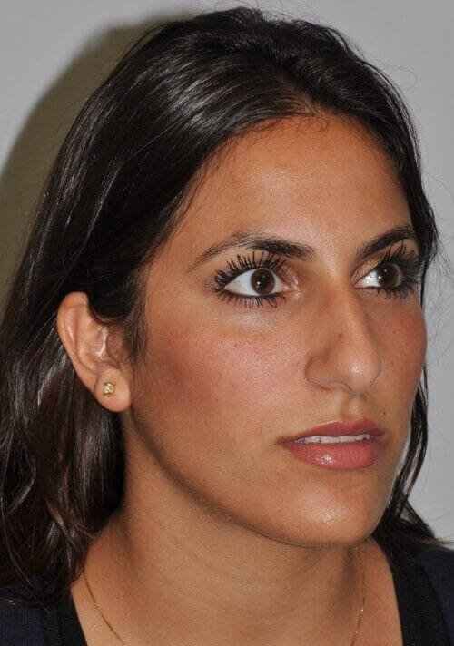 Rhinoplasty Before & After Patient #6139