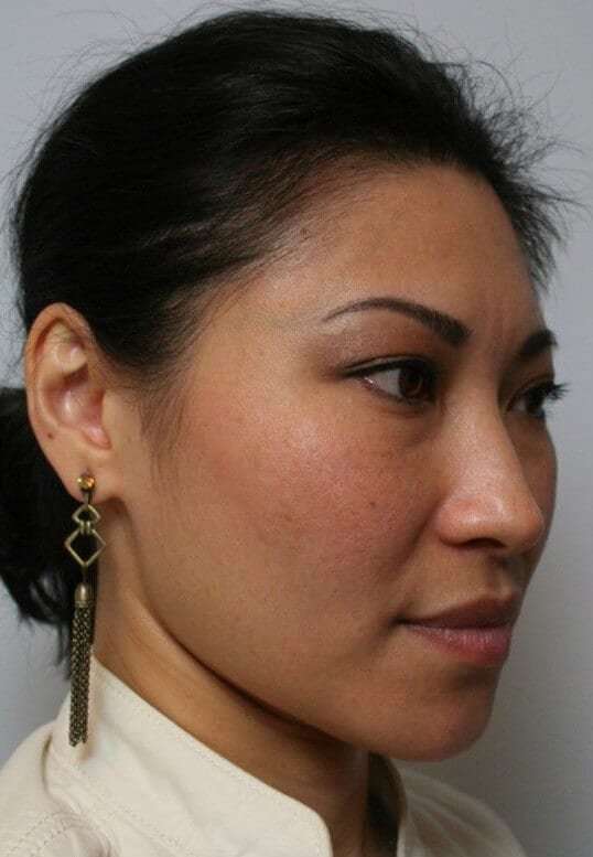 Rhinoplasty Before & After Patient #6146