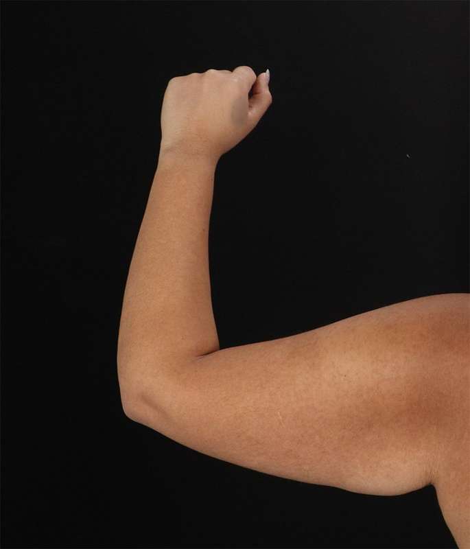 Brachioplasty (Arm Lift) Before & After Patient #1150