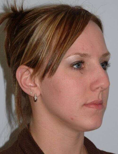 Rhinoplasty Before & After Patient #6153