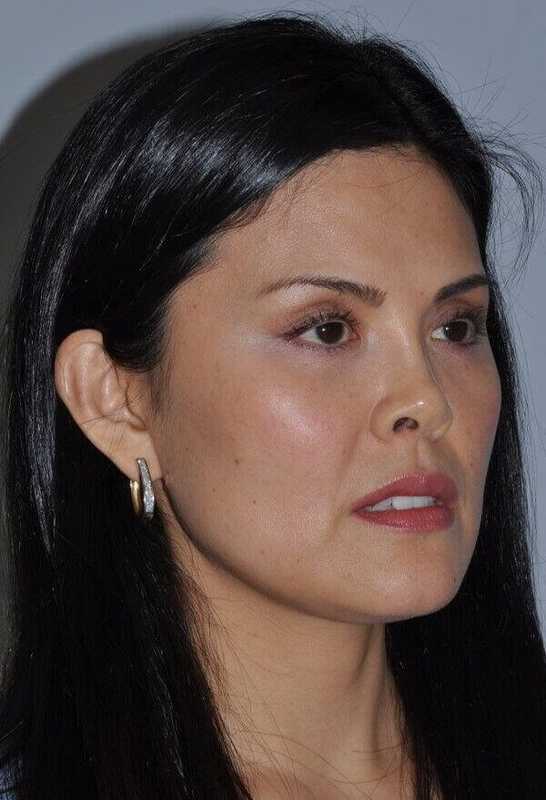 Rhinoplasty Before & After Patient #6167