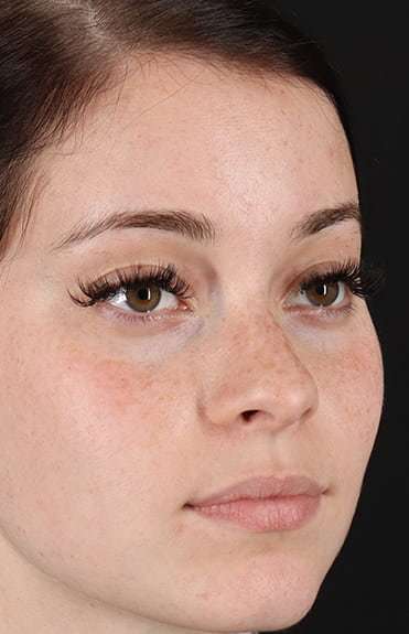 Rhinoplasty Before & After Patient #6178