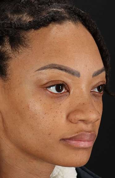 Rhinoplasty Before & After Patient #6189