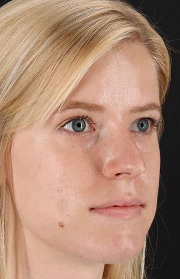 Rhinoplasty Before & After Patient #6200