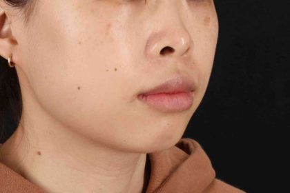 Lip Reduction Before & After Patient #6222