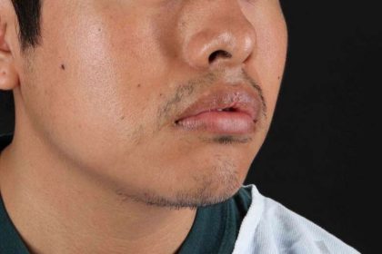 Lip Reduction Before & After Patient #6233