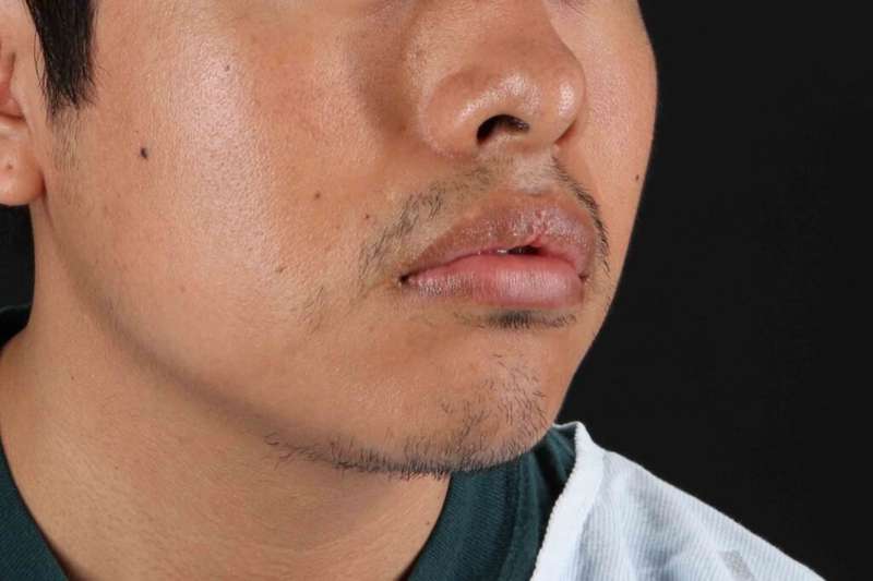 Lip Reduction Before & After Patient #6233