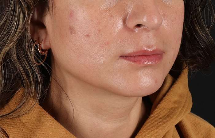 Lip Lift Before & After Patient #6244