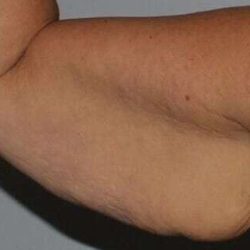 Brachioplasty (Arm Lift) Before & After Patient #1160