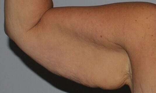 Brachioplasty (Arm Lift) Before & After Patient #1160
