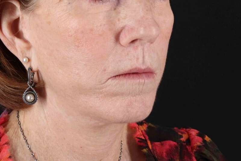 Lip Lift Before & After Patient #6255