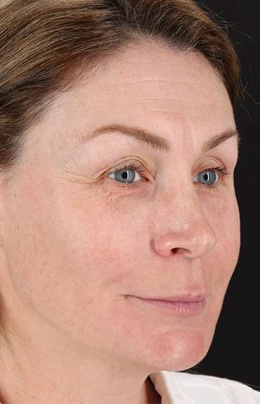 Lip Lift Before & After Patient #6266