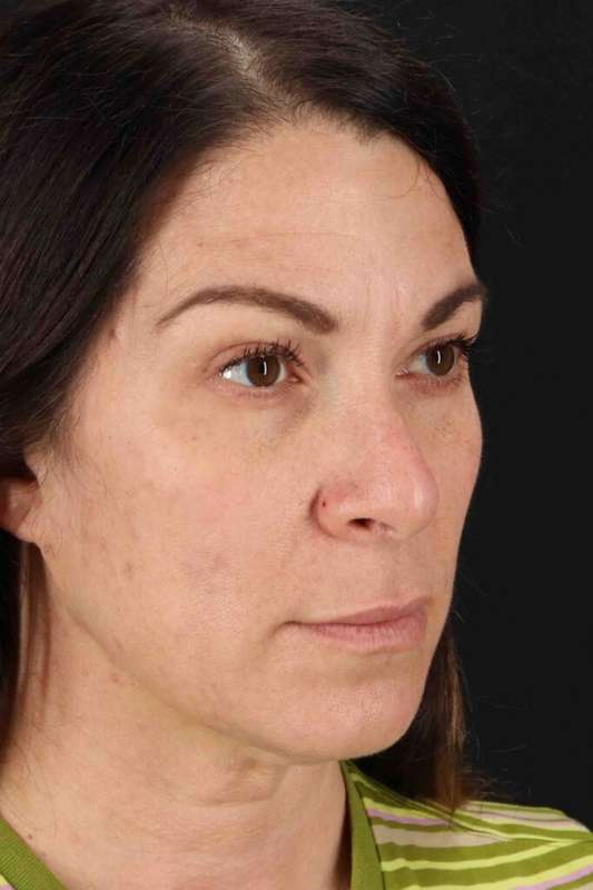 Lip Lift Before & After Patient #6277