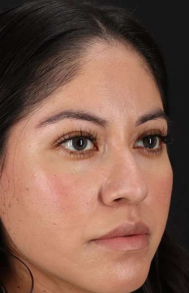 Liquid Rhinoplasty Before & After Patient #6319
