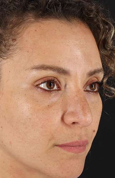 Liquid Rhinoplasty Before & After Patient #6333
