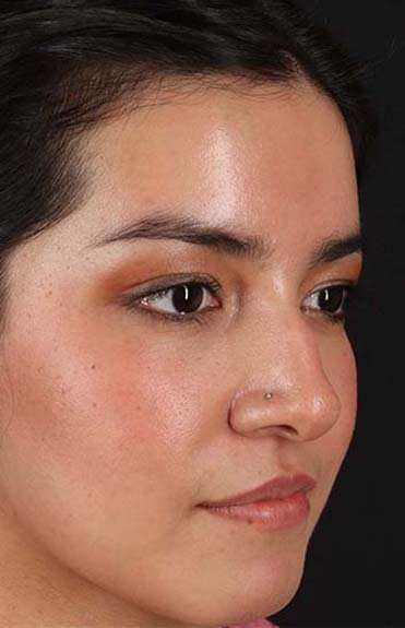 Liquid Rhinoplasty Before & After Patient #6344