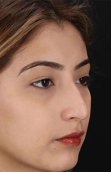 Liquid Rhinoplasty Before & After Patient #6355