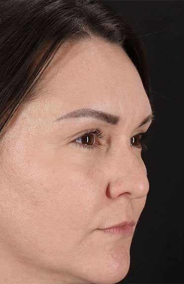 Liquid Rhinoplasty Before & After Patient #6366