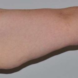 Brachioplasty (Arm Lift) Before & After Patient #1166