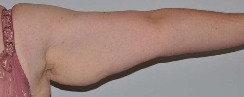 Brachioplasty (Arm Lift) Before & After Patient #1166